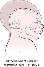 Comparative anatomical image of the head and skull of a newborn child with a normal cranium and with microcephaly and severe microcephaly. Virus of Zika. Vector. Isolated on white background