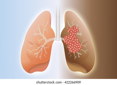 Comparative between healthy lung and cancer lung on difference background.