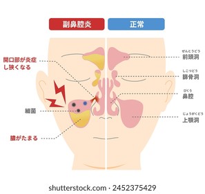 Comparative chart of how and why chronic sinusitis occurs [TRANSLATE];Sinusitis
Healthy Sinus ,Obstructed sinus opening ,Excess MucusSinus Infection