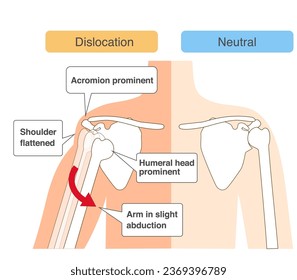 Comparative chart of shoulder joint dislocation mechanism - Shutterstock ID 2369396789