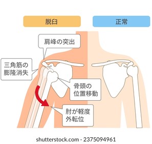 Gráfico comparativo del mecanismo de dislocación de las articulaciones de los hombros ;Acrómion transversal prominente
,Hombro aplanado
,Cabeza humeral destacada
,Brazo en ligero secuestro