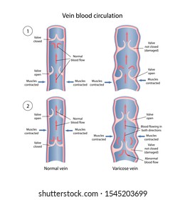 Comparative diagram of venous circulation with normal and varicose veins. A longitudinal section of a vein with a description of the main parts. Vector illustration