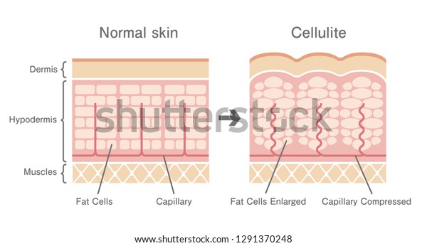 Comparative Illustration Normal Skin Cellulites Skin Stock Vector 