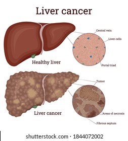 Comparative image of healthy liver and liver with cancer