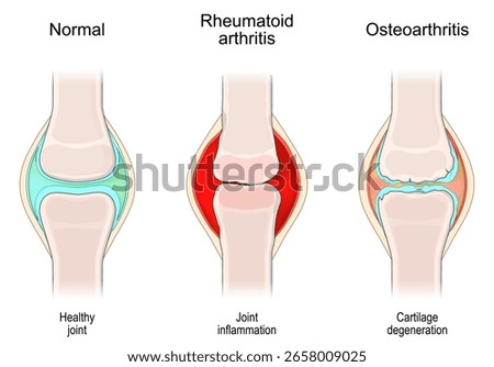 Comparative Joint Pathology. Healthy joint,  Rheumatoid arthritis, Osteoarthritis. Normal articulation, autoimmune disorder and Joint inflammation, Cartilage degeneration. OA vs RA.