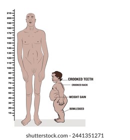 Comparative table of height between acromegaly (left) and dwarfism (right).