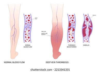 Compare Between Healthy And Thrombosis Blood Clot In The Leg Veins Anatomy