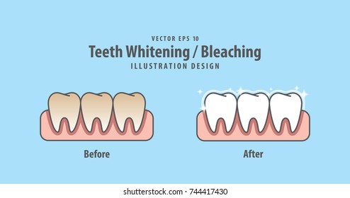 Compare teeth Whitening-Bleaching before and after illustration vector on blue background. Dental concept.