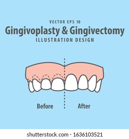 Compare upper teeth Gingivoplasty & Gingivectomy surgery before and after electrosurgery cut gum off illustration vector on blue background. Dental concept. 