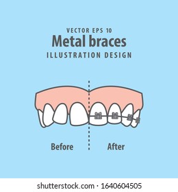 Compare upper teeth Metal braces before and after illustration vector on blue background. Dental concept.