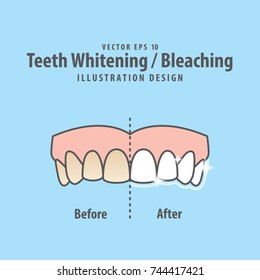 Compare upper teeth Whitening-Bleaching before and after illustration vector on blue background. Dental concept.