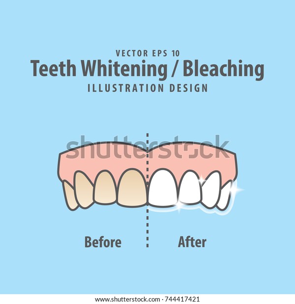 青の背景に上歯のホワイトニング ブリーチング 白くする とイラストベクター画像の前後を比較します 歯科のコンセプト のベクター画像素材 ロイヤリティフリー