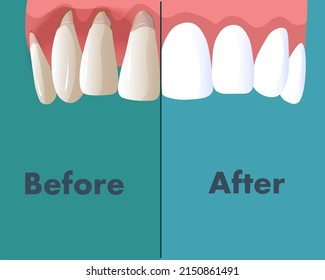 compare vector images Before and after dental treatment teeth on a blue background
