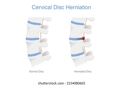 Comparing normal cervical disc and disc herniated of the patient.
Illustration of Medical diagram about the problem on the spine makes pain or disability.