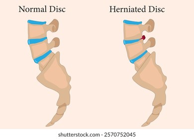 Comparing normal cervical disc and disc herniated of the patient. Illustration of Medical diagram about the problem on the spine makes pain or disability. EPS 10