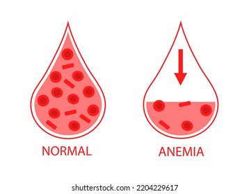 Comparing Two Drops Of Blood Normal And Anemic Blood Cells. Low Hemoglobin. Isolated Image On White Background.