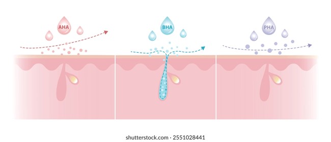 Comparação das características dos ácidos alfa, beta, poli-hidroxi ilustração. AHA esfoliar a pele superficial. BHA penetrar profundamente no poro. PHA dissolver a superfície, molécula grande, penetrar menos.