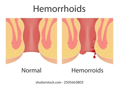 Comparación de la anatomía normal y la enfermedad hemorroidal del ano, la inflamación causa sangrado a través de la fístula del paciente.