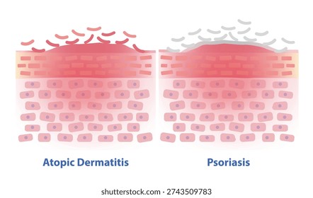 Comparison of Atopic Dermatitis and Psoriasis skin vector illustration. Cross section of skin barrier layer eczema, dry, itchy, red, inflamed skin and Psoriasis plaques are thick, silvery scales.