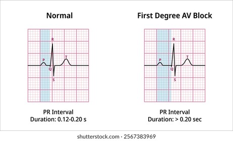 Comparison of AV Block Degree 1 and Normal ECG Waveforms