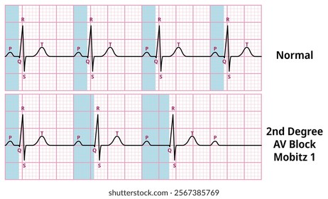 Comparison of AV Block Degree 2 Mobitz type 1 and Normal ECG Waveforms