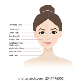 Comparación antes y después de las arrugas faciales en la Ilustración vectorial facial de la mujer. Frente, conejito, marioneta, líneas de ceño fruncido, pliegue mental, patas de gallo, canales de lágrimas, pliegues nasolabiales, sonrisa, líneas del cuello.