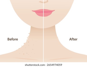 Comparación de antes y después de la Ilustración vectorial removedor de papilomas cutáneos del lado del cuello de mujer. Los papilomas cutáneos son Pequeños pedazos de piel sobrantes que sobresalen de la superficie. Concepto de cuidado de la piel y belleza.