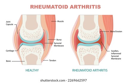 comparison between healthy joint and rheumatoid arthritis