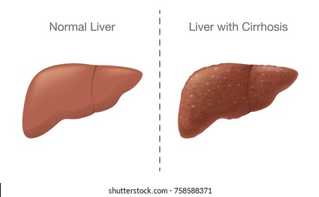 Cirrhosis Stock Images, Royalty-Free Images & Vectors | Shutterstock