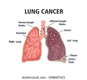 Comparison Between Healthy Lung Cancer Lung Stock Vector (Royalty Free ...