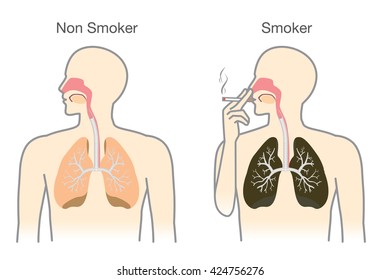 Comparison between lung of smoker and non smoker. This illustration about medical.