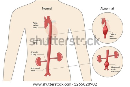 The comparison between normal aorta and aortic aneurysm in the thoracic and abdominal area, healthcare and medical illustration about injury