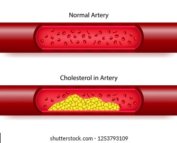 Comparison between normal artery and cholesterol in artery, vector illustration eps10