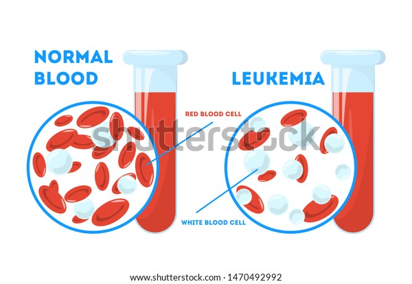 Comparison between normal blood and leukemia. Dangerous illness