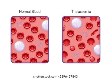 Comparison between normal blood and thalassemia vector. blood smear. Medical education. 