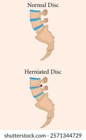 Comparison between normal and herniated spinal discs with clear visual differences. vector eps 10