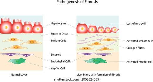 Vergleich zwischen normaler Leberschädigung und Leberschädigung mit Fibrosebildung  