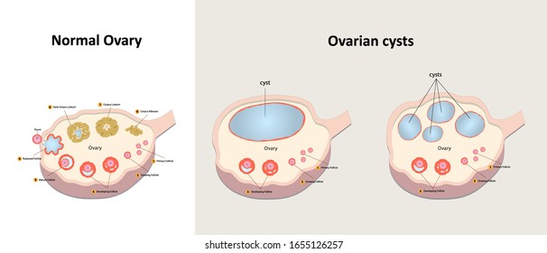 Comparison Between Normal Ovary And Ovarian Cysts 