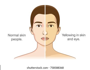 
The Comparison between normal people and yellowing of the eyes and skin. Illustration about health problems.