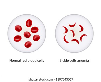 Comparison Between Normal Red Blood Cells Stock Vector (Royalty Free ...