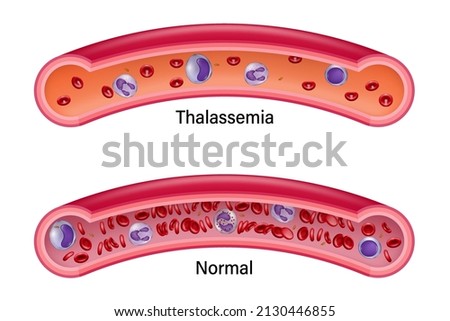 Comparison between normal red blood cells and thalassemia. Medical education.