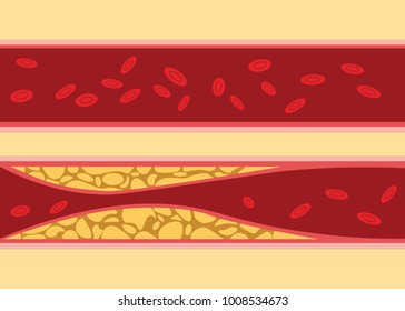 Comparison Between Normal And Unhealthy Cholesterol Human Blood Vein Cell Stream Flow With Fat On Side With Flat Style Illustration