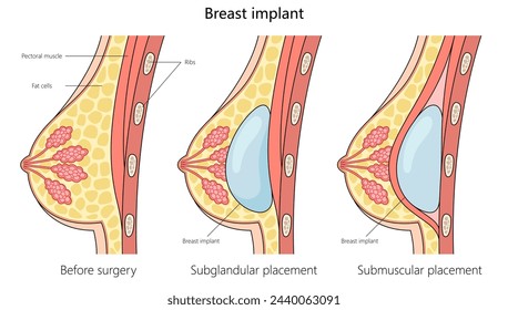 comparison of breast anatomy before surgery and with subglandular and submuscular breast implant placements structure diagram hand drawn vector illustration. Medical science educational illustration