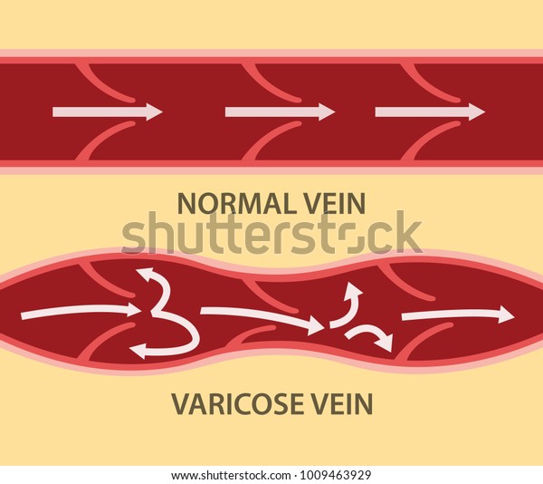 Comparison Compare Between Normal Vein Varicose Stock Vector (Royalty ...