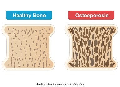 Comparison of cross-sectional views of osteoporotic and normal bone