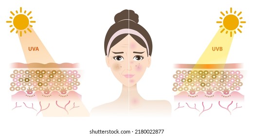 Comparison of damaged woman face from UVA and UVB rays vector on white background. Resulting in a tan, melasma, aging, wrinkle, dark spots, burn, inflammation, red spots. Skin care and beauty concept 