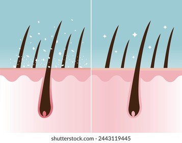 Comparison of dandruff in hair and healthy hair on scalp layer vector illustration. Hair with white dry flaky, scaly scalp and nourished. Hair care and problem concept.