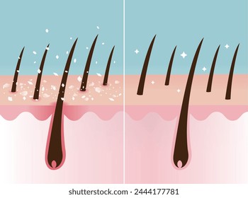 Comparison of dandruff and healthy hair on scalp layer vector illustration. Cross section of scaly scalp, white dry flaky in hair and nourished hair. Hair care and problem concept.