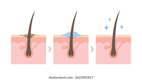 Comparison of dandruff and healthy hair on scalp layer vector illustration. Cross section of scalp. Cleansing the scalp.