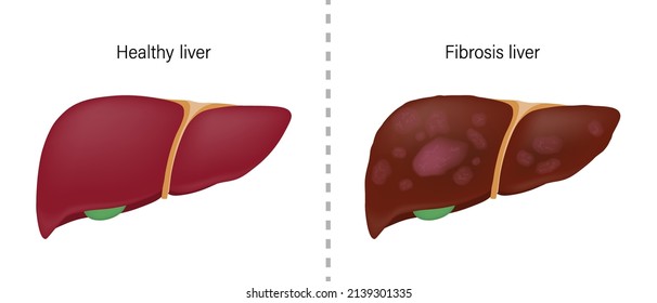 1,567 Normal Liver Images, Stock Photos & Vectors | Shutterstock